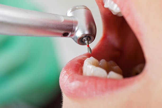 Best Emergency Wisdom Teeth Removal in Belle Isle, FL